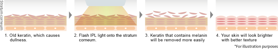 Release dull keratin through IPL light treatment