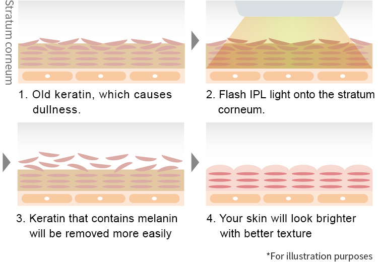 Release dull keratin through IPL light treatment